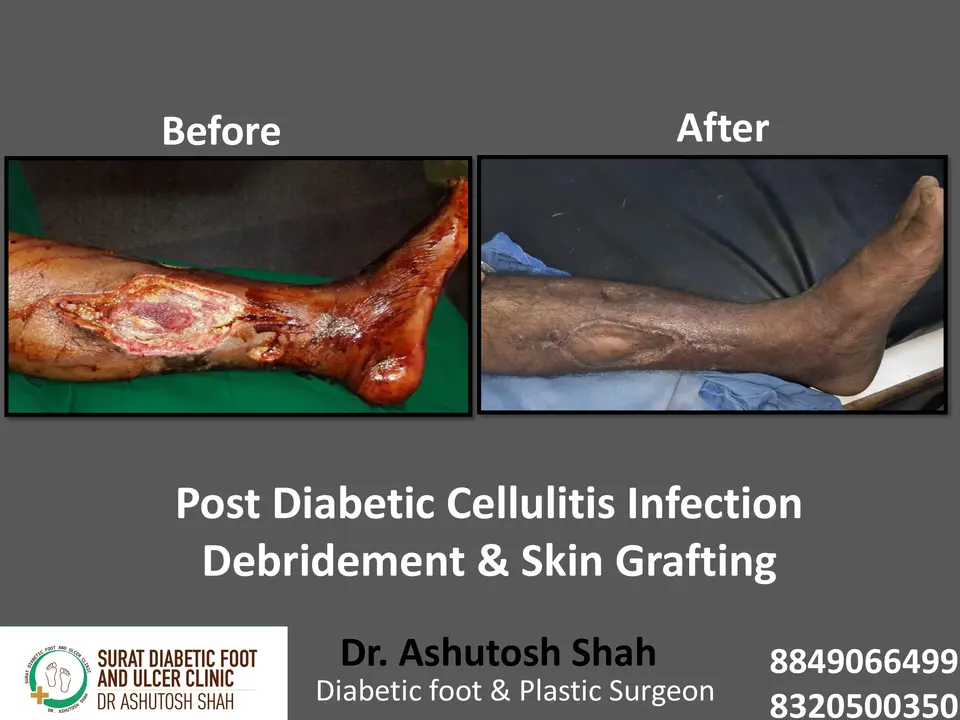 Diabetic Cellulitis and Coverage.pptx-7.webp